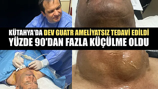 Kütahya'da dev guatr ameliyatsız tedavi edildi: Yüzde 90'dan fazla küçülme oldu