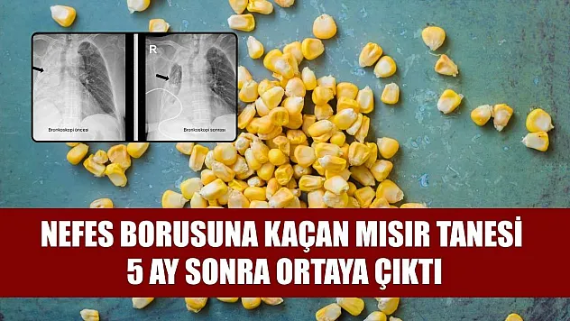Nefes borusuna kaçan mısır tanesi 5 ay sonra ortaya çıktı