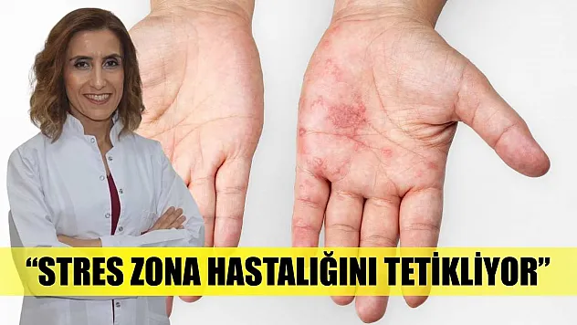 'Stres zona hastalığını tetikliyor'