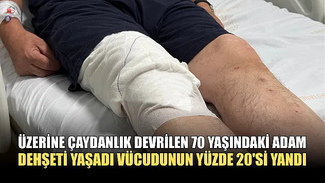 Üzerine çaydanlık devrilen 70 yaşındaki adam dehşeti yaşadı, vücudunun yüzde 20'si yandı