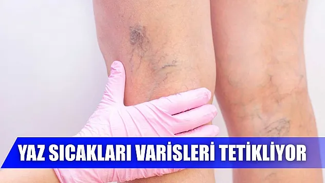 Yaz sıcakları varisleri tetikliyor