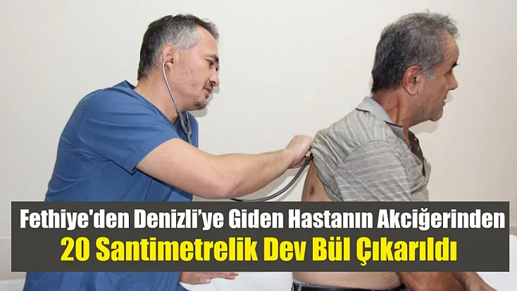 Fethiye'den Denizli’ye giden hastanın akciğerinden 20 santimetrelik dev bül çıkarıldı