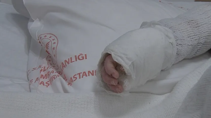 Üzerine kaynar su dökülen bebeğin vücudunun yüzde 27'si yandı